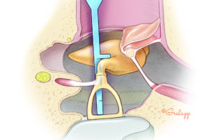 The tympanomeatal flap (canal skin and eardrum) has been raised and reflected anteriorly to expose the posterior half of the middle ear. To aid in selection of the proper length prosthesis, the distance from the lateral surface of the incus to the footplate is being measured.