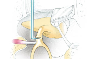 Division of the joint between the incus and stapes using an incudostapedial joint knife.