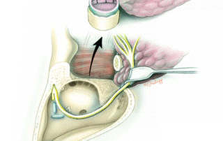 Lateral temporal bone resection may include a resection of the parotid and condylar head in continuity with the ear canal.