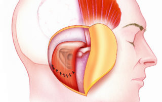 To foster rapid healing in preparation for radiotherapy, the posterior half of the temporalis muscle can be rotated as a flap. Securing the flap to the sternocleidomastoid muscle is a very effective means of setting the flap into position. Leaving the cavity open predisposes to the development of osteoradionecrosis. Hearing is unlikely to be rehabilitated in an ear that is to be subjected to radiation at the level of 60 to 70 Gy.