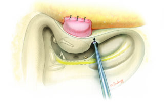 While connecting the facial recess into the hypotympanum, the chorda tympani nerve is sharply transected. Care must be taken while working in this narrow interval to avoid injury to the descending facial nerve with the shaft of the drill. A cut is then made parallel to the bony ear canal through the front face of the mastoid.