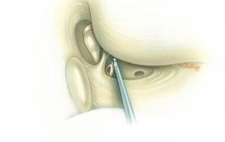 Working via the facial recess, the incudostapedial joint is severed sharply. A disposable myringotomy knife is a convenient tool for accomplishing this maneuver.
