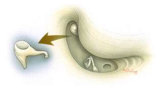The bone bridge separating the epitympanum from the facial recess is then drilled away and the incus is removed. The tensor tympani muscle also needs to be transected (not shown here).