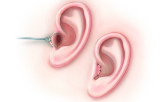At the beginning of the temporal bone resection for ear canal malignancy, the ear canal is transected and the meatus sutured closed. The lateral margin is sent for frozen section. Note that the technique employed is different from that used during skull base surgery (see 12.5 Ear Canal Closure). Simply sewing the tragal skin to the conchal margin permits resection of the skin of the entire ear canal. To break the spring of the conchal cartilage, it is crosshatched with a scalpel.