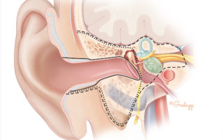 Temporal bone resection for malignancy encompasses three related procedures of progressively increasing depth: sleeve resection of the external auditory canal (solid line), lateral temporal bone resection (dotted line), and total temporal bone resection (dashed line). The illustration depicts these procedures in the coronal view. Most of these resections are performed for squamous cell carcinoma arising from the external auditory canal. It is generally acknowledged that sleeve resection is an insufficient therapy for malignant disease. In the lateral temporal bone resection, the ear canal is removed en bloc with the tympanic membrane and lateral ossicles. A parotidectomy and/or neck dissection often supplements the temporal bone specimen. In total temporal bone resection, creation of an en bloc specimen is difficult and probably unnecessary. It requires an extensive dissection of the intrapetrous carotid artery, a measure usually of little benefit in deeply invasive squamous cell carcinoma. Most contemporary otologists perform the so-called total temporal bone resection by first carrying out a lateral temporal bone resection and then removing the medial petrous bone piecemeal with a drill. This procedure is indicated for deep extension which penetrates beyond the medial wall of the middle ear and/or mastoid.