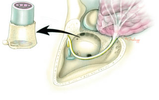 The specimen in a lateral temporal bone resection includes both the cartilaginous and osseous ear canal as well as the tympanic membrane with malleus attached.