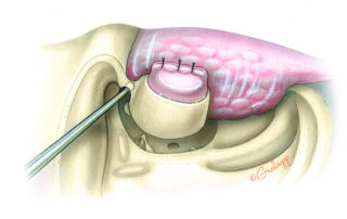 Working between the floor of the middle cranial fossa and the roof of the ear canal, the root of the zygoma is drilled away. It is necessary to continue drilling until the anterior epitympanum has been opened into the glenoid fossa.