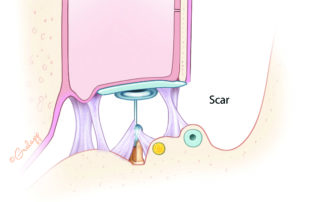 Ossiculoplasty performed in a single stage with poor middle ear mucosa may result in scarring with either displacement or impaired vibration of the prosthesis.