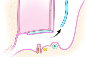 Removal of silicon rubber sheet at second stage. Note the healthy middle ear mucosal envelope.