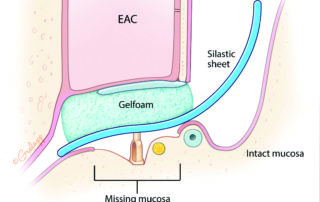 Staging ossiculoplasty may be best when a sizable portion of the middle ear mucosa is diseased or absent. During the first stage, the cartilage graft is placed and silicon rubber sheet inserted to discourage scarring.