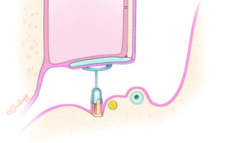 Placement of partial ossicular chain prosthesis into a middle ear with a healthy mucosal envelope is a key factor in obtaining favorable hearing outcomes.