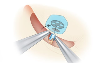 Using a suction to stabilize and a hook to position, the prosthesis is rotated into position.