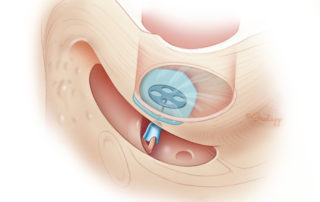 Prosthesis in position.