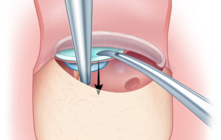 The shaft of a suction can be used to help stabilize the prosthesis during cartilage placement.