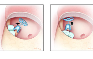 Packing placed superiorly over the facial nerve or posteriorly can actually destabilize the prosthesis.