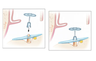 Insertion of the prosthesis.