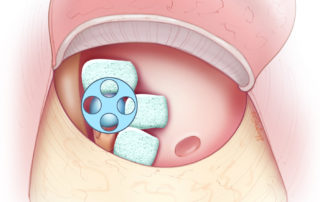 Prostheses tend to be less stable inferiorly and anteriorly and are more likely to displace in those directions. Packing is used to counter this tendency.