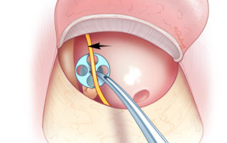 When the chorda tympani is intact, using it as a sling to establish longitudinal tension is helpful in stabilizing the prosthesis.