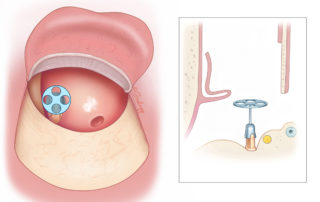 Partial ossicular replacement prosthesis in position prior to placement of cartilage.