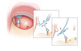 Tilting the prosthesis anteriorly before contacting the cartilage.
