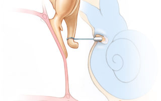 A piston stapes prosthesis crimped onto the long process of the incus and is anchored in surgically created footplate fenestra (stapedotomy). A piston stapes prosthesis crimped onto the long process of the incus and is anchored in surgically created footplate fenestra (stapedotomy).
