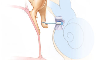 Stapes prosthesis in place following total stapedectomy with tissue grafting covering the oval window. Stapes prosthesis in place following total stapedectomy with tissue grafting covering the oval window.