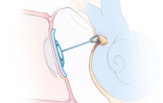 Use of a long titanium partial ossicular replacement prosthesis (PORP) onto an anterior crural remnant sufficient to serve as an anchor. Use of a long titanium partial ossicular replacement prosthesis (PORP) onto an anterior crural remnant sufficient to serve as an anchor.