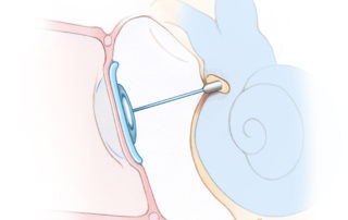Total ossicular replacement prosthesis (TORP). To discourage extrusion, autologous cartilage is interposed between the prosthesis and the tympanic membrane. Total ossicular replacement prosthesis (TORP). To discourage extrusion, autologous cartilage is interposed between the prosthesis and the tympanic membrane.