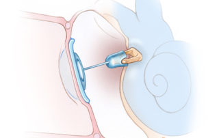 Titanium partial ossicular replacement prosthesis (PORP). To discourage extrusion, autologous cartilage is interposed between the prosthesis and tympanic membrane. Many surgeons use this form of reconstruction whenever the incus is deficient regardless of the status of the malleus. Titanium partial ossicular replacement prosthesis (PORP). To discourage extrusion, autologous cartilage is interposed between the prosthesis and tympanic membrane. Many surgeons use this form of reconstruction whenever the incus is deficient regardless of the status of the malleus.