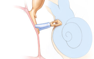Ceramic crutch and cup-type prosthesis connecting the malleus long process (manubrium) with the capitulum of the stapes. Because the manubrium lies anterior to the stapes, and is often medialized due to retraction and scarring from infection, it is often challenging to achieve stability. Both crutch and cup often need to be modified with a drill to mortise into position. Ceramic crutch and cup-type prosthesis connecting the malleus long process (manubrium) with the capitulum of the stapes. Because the manubrium lies anterior to the stapes, and is often medialized due to retraction and scarring from infection, it is often challenging to achieve stability. Both crutch and cup often need to be modified with a drill to mortise into position.