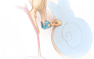 Applebaum ceramic prosthesis spanning a distal long process defect. Applebaum ceramic prosthesis spanning a distal long process defect.