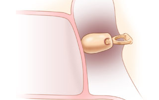 Use of the malleus head in reconstruction on top of the stapes capitulum. Because of the top-heavy nature of this reconstruction, it may be mechanically unstable.