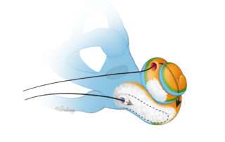 Upon creation of a mid-turn cochleostomy, a split array can be placed. One array is placed as far as possible into the basal turn. The other array can be threaded into the mid-turn in an antegrade fashion if possible. A retrograde insertion (as shown) can also be considered if that provides for a greater number of intracochlear electrodes.