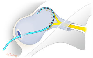 The loop deploys peripherally in proximity to neural elements. This technique reduces the risk of the electrode penetrating the internal auditory canal.