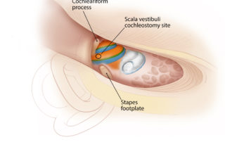 A mid-turn cochleostomy can be performed, though the facial recess after the incus, incudal buttress, and stapes superstructure are removed. Drilling can then be performed in the area between the anterior oval window and the base of the cochleariform process. Although this will usually enter into the scala vestibuli, any lumen can be used if this approach is needed.