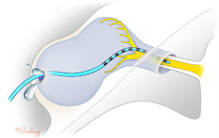 In severe inner ear malformation, it is common to have poor partitioning between the deformed inner ear and cerebrospinal fluid (CSF) space at lateral extremity of the internal auditory canal. This can result in brisk CSF leakage. In addition, a straight electrode is prone to penetrate the internal auditory canal. It is prudent to obtain an intraoperative X-ray to ensure proper placement.