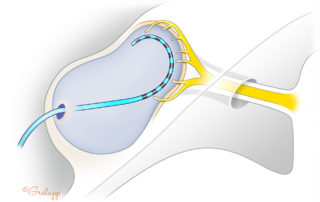 A straight electrode advances along the periphery of the cavity in proximity to the auditory dendrites and ganglia.