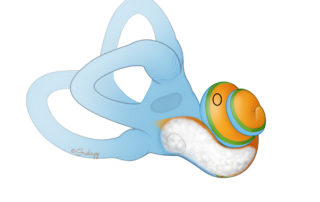 In the case of ossification or fibrosis, the basal turn is often the most affected portion of cochlea. In such cases, the round window niche may be replaced by fibrotic tissue and “chalky” new bone.