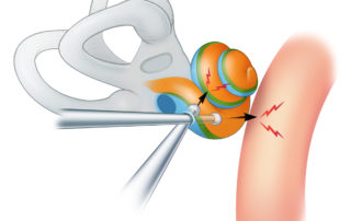 Maintaining orientation within an abnormal cochlea can be challenging, whether the distorted anatomy is from fibrosis, ossification, or congenital malformation. The surgeon must maintain orientation using whatever landmarks are present. Removal of bone too superior can risk entering the modiolus, thereby injuring neural tissues and creating an iatrogenic spinal fluid leak. Similarly, drilling too far anteriorly risks injury to the genu of the intratemporal carotid.