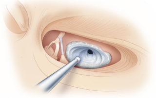 Drilling anteriorly through calcification of the basal turn to reach an open scala vestibuli.