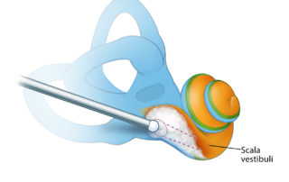 Drilling anterior, and following the abnormal bone along the path expected for the basal turn, may eventually lead to an opening in the more anterior aspect of the cochlea. This may enable a complete insertion of a conventional array into the cochlea. Often the scala vestibuli is relatively less affected than the scala tympani, providing a path for insertion. A combination of preoperative high-resolution CT and MRI sequences optimized to show intracochlear fluids can be invaluable in planning for such cases.