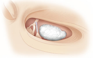 Most ossification relevant to cochlear implantation lies within the cochlear lumen, but occasionally it extends into the middle ear and obscures the round window. This illustration depicts a plaque of dystrophic calcification obscuring the round window.