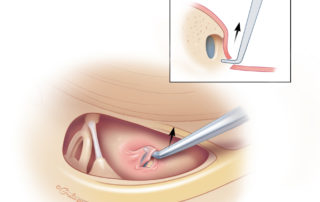 The round window niche is often covered by a layer of mucosa, sometimes referred to as the “round window niche membrane.” This membrane can be differentiated from the true round window membrane by its location at the opening of the niche and its more pink color in comparison to the bluish round window membrane. When encountered, this mucosa can be gently dissected away from the underlying niche and round window membrane with a small right-angled hook.