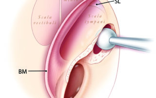 Schematic depiction of a cochleostomy into the inferior aspect of the scala tympani. This minimizes cochlear injury by avoiding both the basilar membrane (BM) and the spiral ligament (SL). The trajectory of drilling should be aimed somewhat superiorly to enter the scala and avoid drilling tangentially past the inferior aspect of the basal turn.