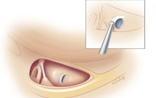 Once the round window niche is identified and cleared of overlying mucosa, the round window membrane can be exposed. The round window membrane is usually bluish in appearance, and has a distinctive white-gray annular ligament at its periphery. Adequate exposure of the round window membrane is essential for optimal electrode placement. The membrane is usually covered to a variable extent by the bone of the round window overhang. A 1-mm diamond burr at low speed can be used to safely remove the overhang while preserving the integrity of the underlying membrane. An adequate view of the anterior margin of the membrane is most important given the optimal trajectory of planned electrode array insertion. Small pieces of gelatin foam sponges with 1:1,000 epinephrine can be used to achieve hemostasis at this point. The avoidance of bone dust or blood is needed to prevent their introduction to the inner ear during array placement. Steroids and hyaluronic acid lubricant can be introduced to the niche at this point if desired.