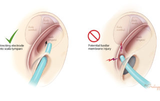 The electrode array is threaded into the scala tympani through the anterior incision in the round window membrane. Note that an anterior trajectory of insertion will guide the array into the basal turn and minimize the risk of direct trauma to the basilar membrane (left panel). A superiorly directed trajectory (right panel) of insertion may cause the array to impact and damage the basilar membrane. Such a direction may result from the suboptimal exposure of the round window membrane from incomplete drilling of the niche overhang, or from incising the round window membrane too far posterior.