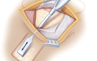 A subperiosteal pocket is created to accept the receiver–stimulator. A device-specific template is used to gauge the size of the pocket, and to mark the location of a bony well to recess and stabilize the electronics case. The pocket should be kept just large enough to comfortably accept the template without the need for excessive force or bending. Using a periosteal elevator to make multiple parallel passes will create a rectangular pocket, and reduce the risk of excessive movement or migration. Care must be taken during this elevation in very young children or those with developmental abnormalities, since the cortical bone over dura may be quite thin or even dehiscent.