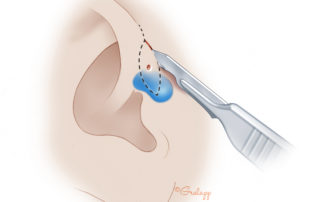Once the blue has dyed the cyst, the removal continues as in Fig. 3.157. If methylene blue seeps from the pit during the early dissection, it is merely suctioned away from the pit.