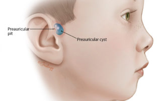 During embryogenesis, the pinna forms from six hillocks: three anterior and three posterior to the external auditory meatus. Preauricular pits result from errors in embryology. As the crus of the helix separates from the tragus, and the incisura deepens between the 1st and 2nd Hillocks of His, a pit can remain. The depth of the sinus varies from person to person. Some are shallow and cause neither drainage nor infection. If the sinus tract becomes obstructed, it may enlarge to form a cyst. These cysts typically adhere to the helical cartilage and sometimes penetrate it. Although commonly limited to the preauricular region, in rare cases tracts can dive either through or beneath the auricular cartilage and may present as a postauricular abscess. They may also be associated with a first branchial cleft fistula that continues parallel to the ear canal or descends deeply into the parotid and even into the upper neck.