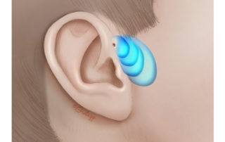 Growth pattern of preauricular cysts. Skin changes sometimes appear discontinuous to the pit.